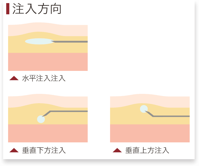 コンデンス脂肪注入 顔 注入方向