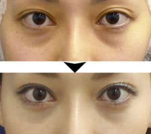 目の下の脂肪取りだけで改善できなかった症例