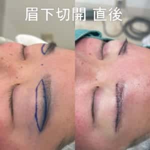 眉下切開のデザインと傷、術直後