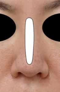 鼻プロテーゼを入れる位置