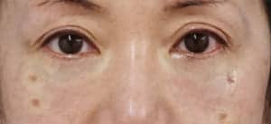 目の下脂肪とり・脂肪注入　手術直後