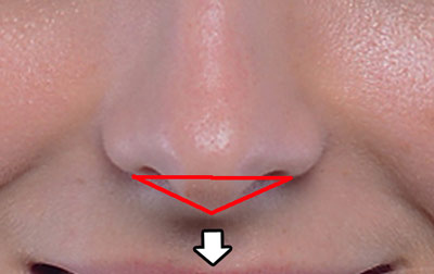 鼻中隔延長-ARC-美しい鼻先