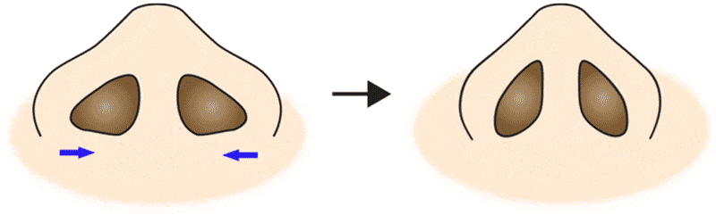 鼻翼縮小（フラップ法）変化
