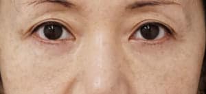 目の下脂肪とり・脂肪注入１か月後