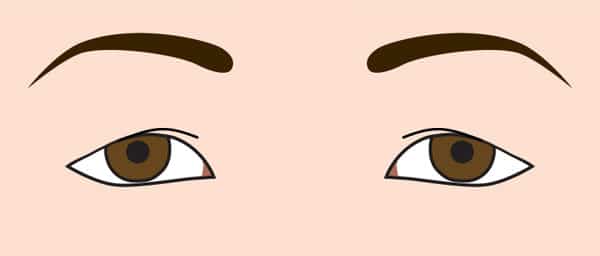 三角目、目の上のたるみ