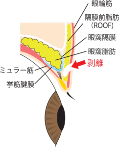 二重全切開剥離