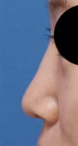 鼻プロテーゼ、鼻尖縮小、軟骨移植　術前