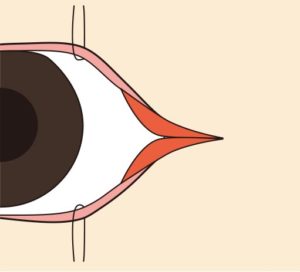 目尻切開目尻全層切開