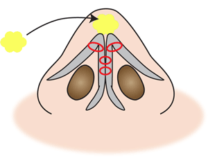 鼻尖縮小軟部組織移植