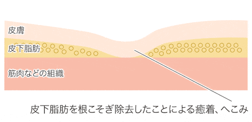 小顔脂肪吸引　癒着 デコボコ