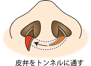 皮弁をトンネルに通す