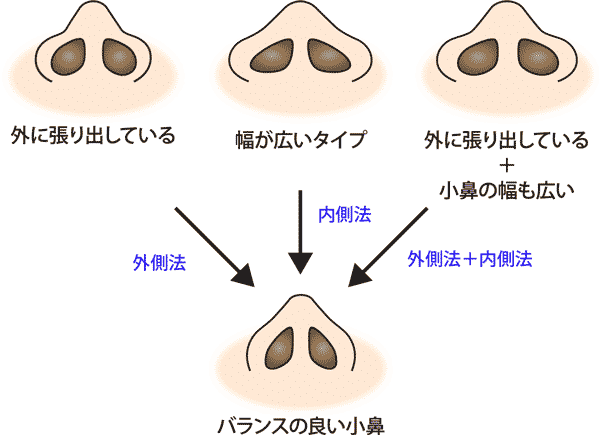 タイプ別鼻翼縮小の種類　小鼻縮小（内側法＋外側法）