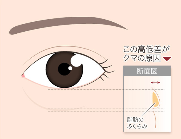 目の下のクマ図 眼窩脂肪 断面