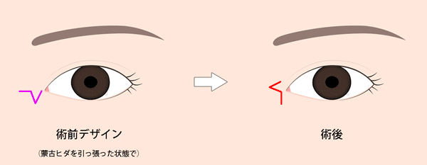 目頭切開（Z形成）の手術イラスト