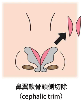 鼻翼軟骨頭側切除 3D法