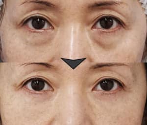 目の下脂肪とりだけでなく目の下脂肪注入もおこなった症例写真