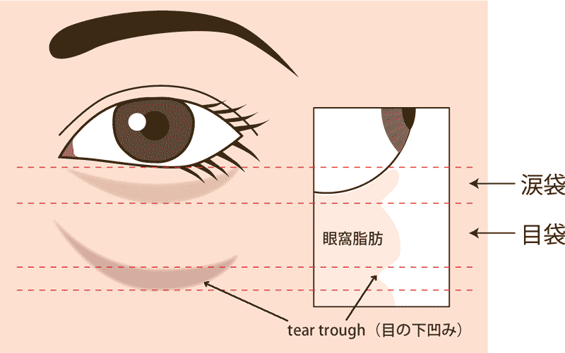 涙袋のヒアルロン酸注入断面図　