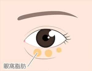 目の下眼窩脂肪、内側・真ん中・外側