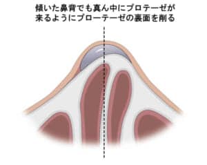 傾いた鼻背に鼻プロテーゼがフィットするように削るイラスト