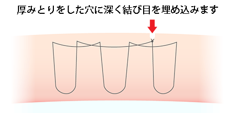 もとびアイゴールド　厚み取り