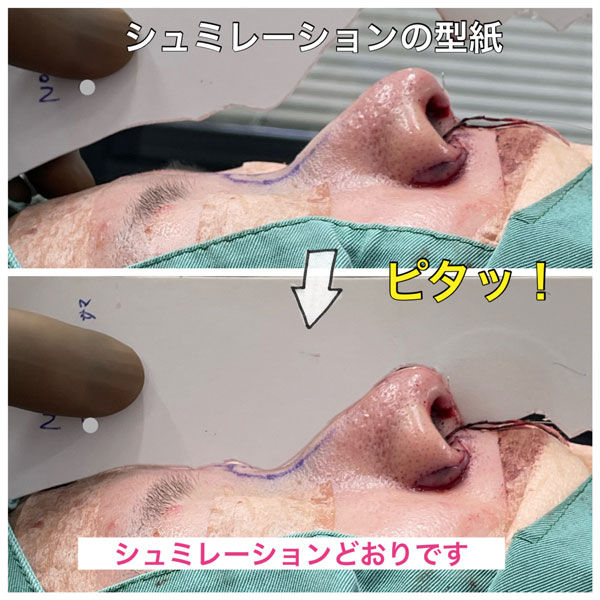 鼻先の手術型紙でチェック