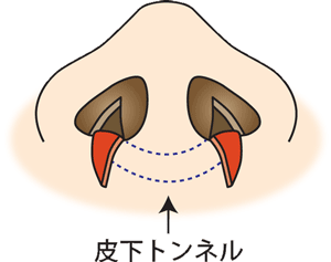 鼻翼縮小-皮下トンネル