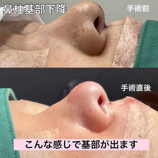 鼻柱基部下降の症例写真（右側面）