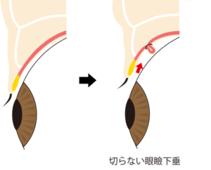 切らない眼瞼下垂変化