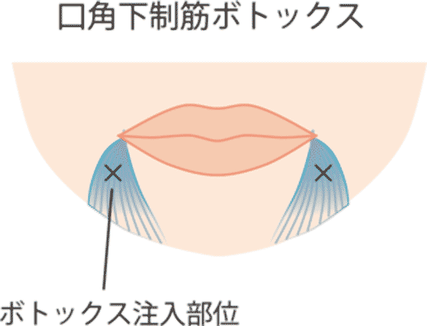 口角を上げるセット　ボトックス注入図