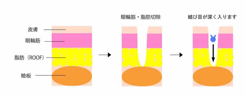 厚み取では結び目が深く入ります