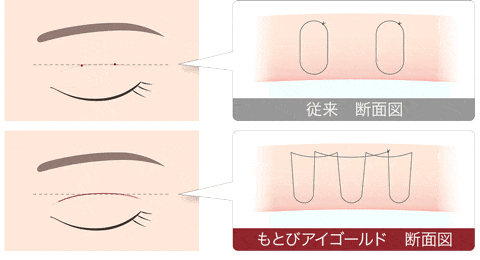 二重埋没法　もとびアイゴー