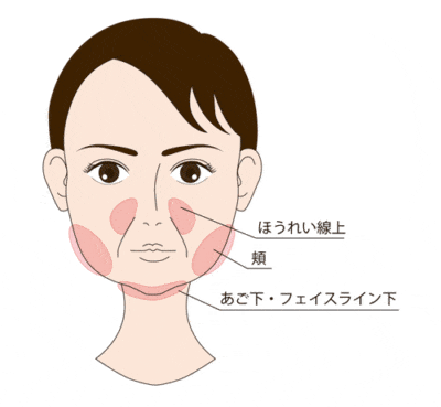 小顔脂肪吸引　顔の脂肪位置