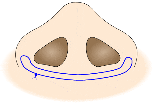 小鼻縮小の減張縫合