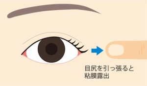 目尻切開シュミレーション
