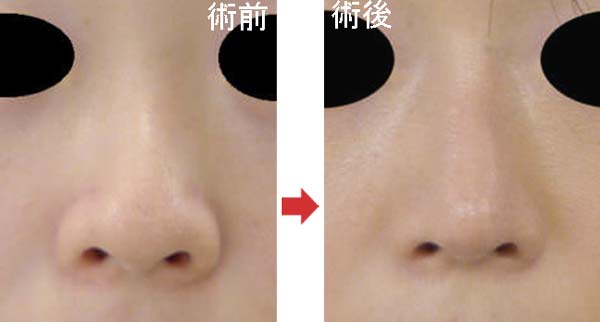 鼻尖縮小と軟骨移植の症例写真