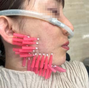 ショッピングスレッド施術の様子