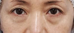 目の下脂肪とり・脂肪注入　手術前