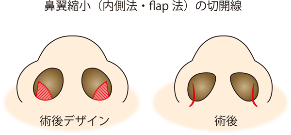 鼻翼縮小（内側法）切開線