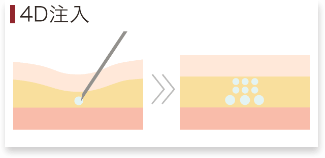 顔 コンデンス脂肪注入 4D注入