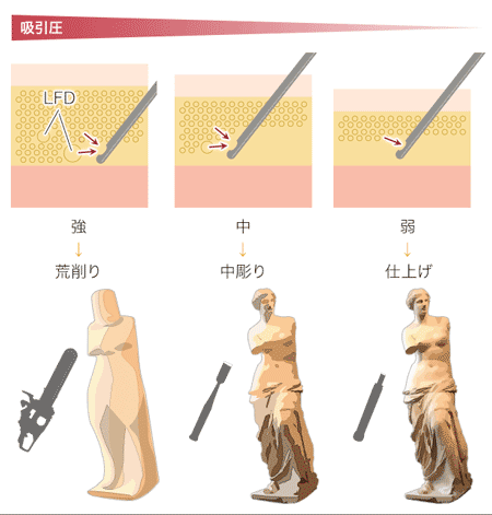 もとび式脂肪吸引法