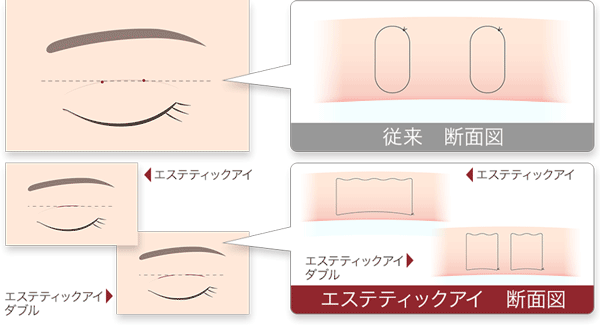 エステティックアイ　断面図