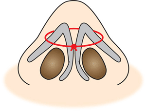 切らない鼻尖縮小の図