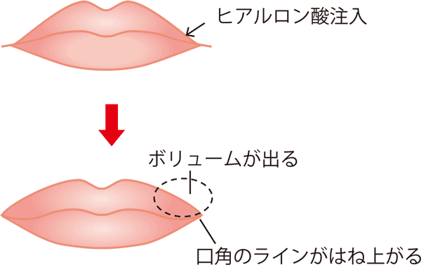 口角を上げるセット　ヒアルロン酸注入