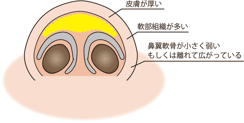 団子鼻解剖-下から断面　切らない鼻整形