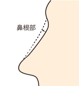 鼻根をクレヴィエルで高くする