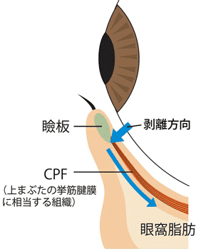 下眼瞼下制剥離の図