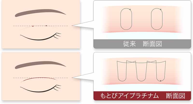 二重埋没法　もとびアイプラチナム断面図