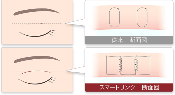 スマートリンク　二重埋没法　断面図