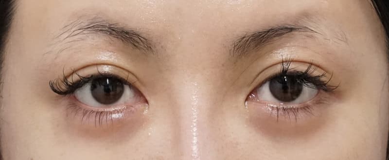 切らない眼瞼下垂　１ヶ月後のBefore写真