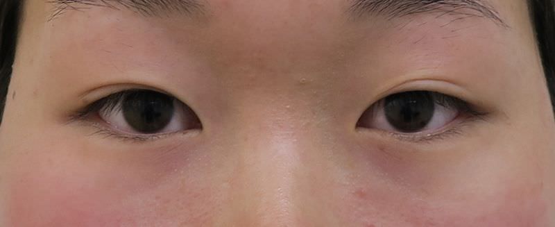 腫れの少ないもとびアイプラチナム　１か月後のBefore写真